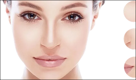 Radiesse Filler